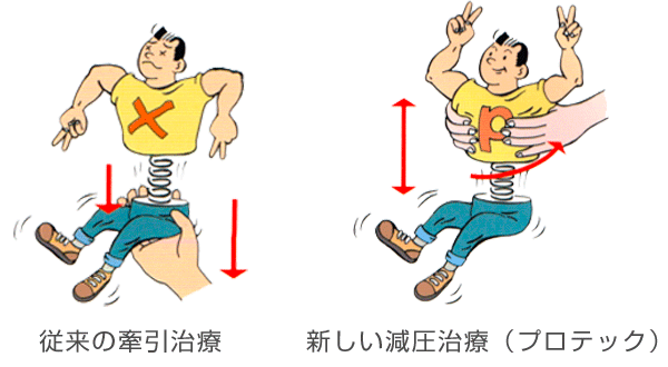 重力除去法と腰部の強制牽引療法の違い